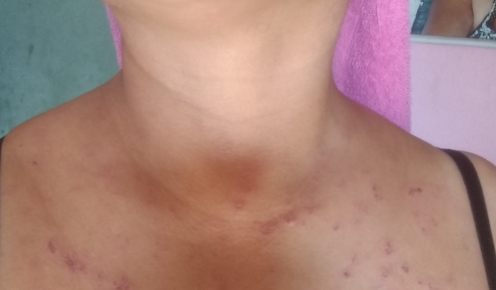 Lupus 