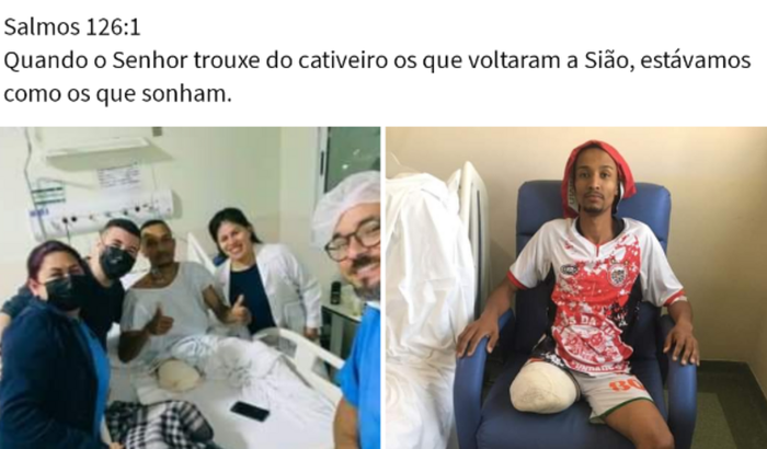 Compra de prótese pós amputação traumática