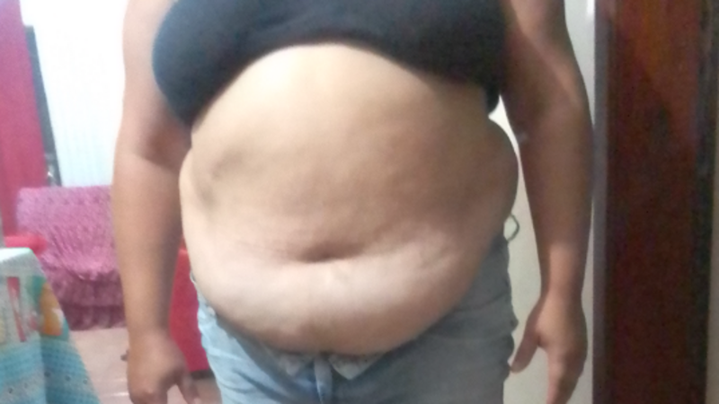 Bariátrica 