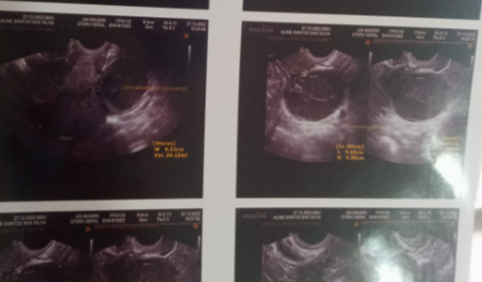 Cirurgia pra minha esposa que está com um cisto hemorrágico 