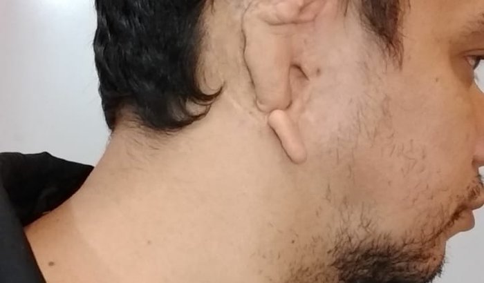 Cirurgia reconstrução orelha esquerda