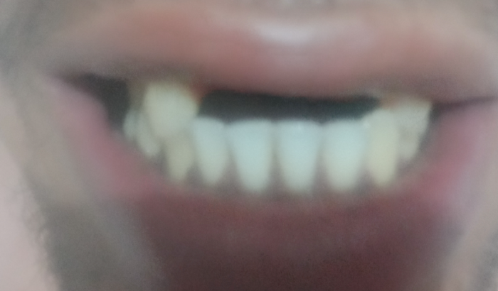 Prótese dentária 