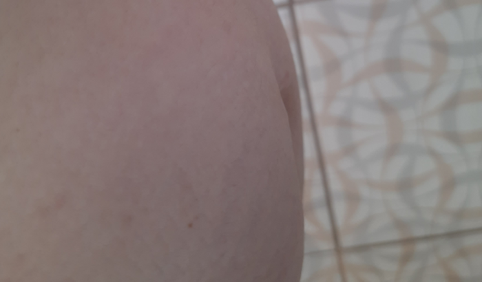 Fazer uma cirurgia de hérnia umbilical  com risco de morte 