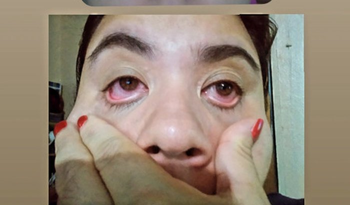 Tratamento de Ceratocone, para Kelly Natacha.