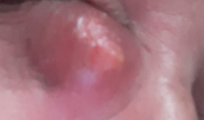 Ajuda para cirurgia de Edite