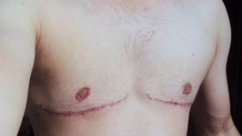 Cirurgia mastectomia