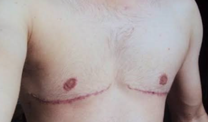 Cirurgia mastectomia