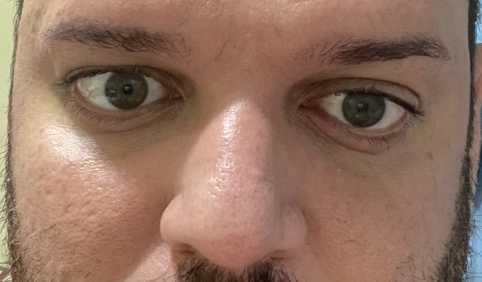 Ajude um portador de ceratocone