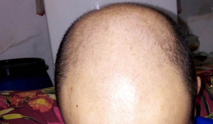 Cirurgia Capilar Transplante.