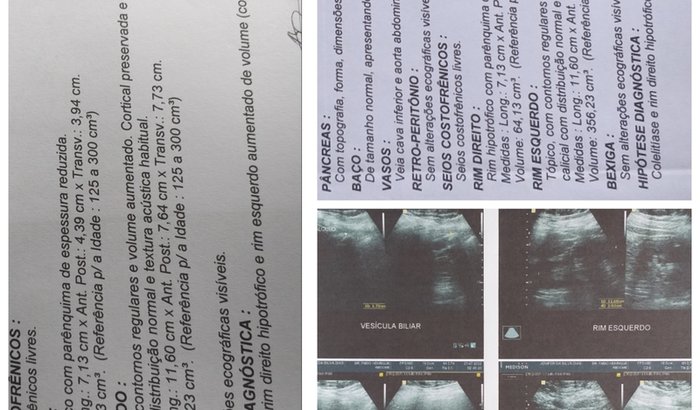 Ajudar jenifer da silva para tratamento dos rins ela so tem um rin