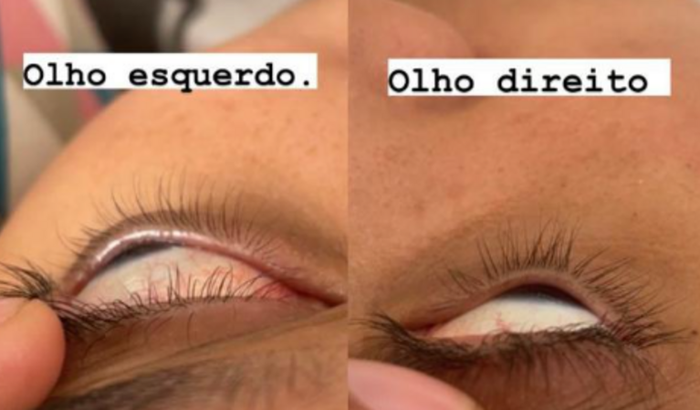 Ajudar na minha cirurgia e Lente de contato