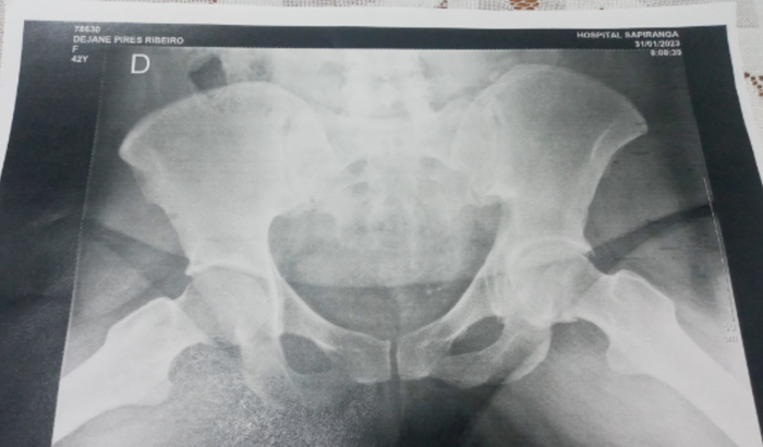 Protese para o Quadril (Artropatia Degenerativa)