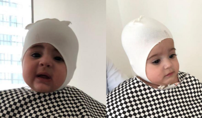 Tratamento de Assimetria Craniana das Gêmeas Liv e Liz