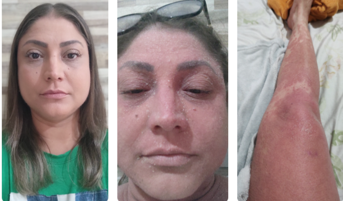 Tratamento câncer raro Eliana de Souza Lima