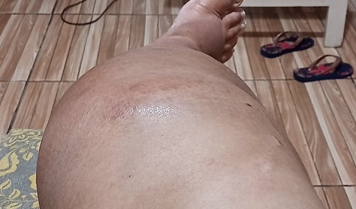 Ajuda a Ana Paula linfodema