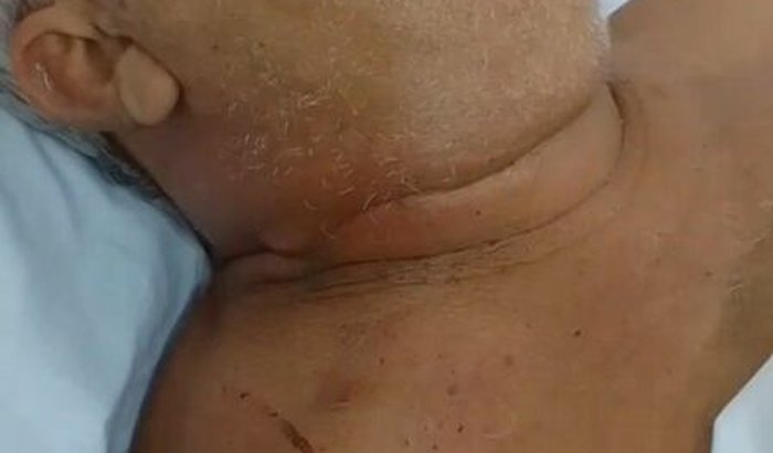 Tratamento de câncer - Unidos por Jorge