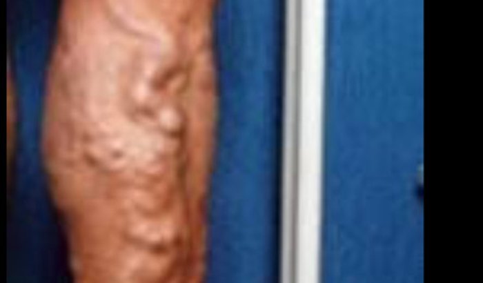 Gente vc pode agudar a minha vó a fazer cirurgia 