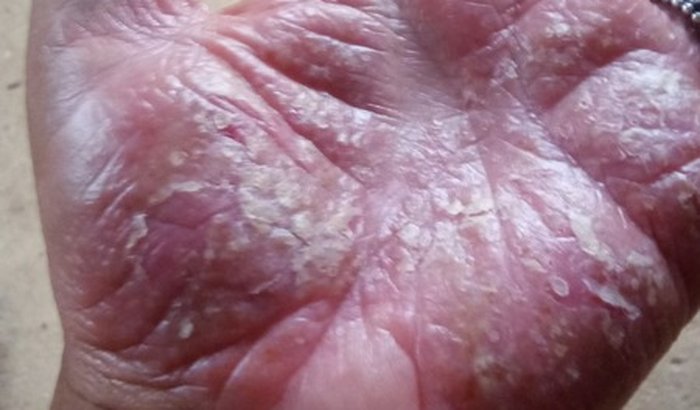 Ajuda Adriana com psoriase pustulosa sem cura