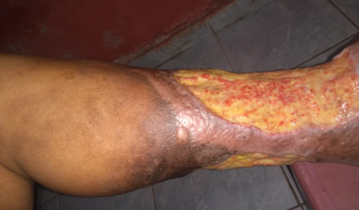 Ajudar uma família carente a fazer o tratamento das duas pernas dela com consulta e materias para curativos