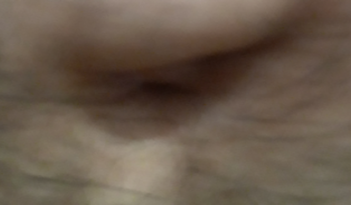 Ajuda pra me tratar dá minha artrose nas costas e minha érnia no umbigo 