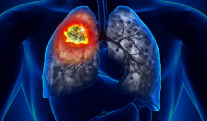 Broncoscopia da Amarelinha