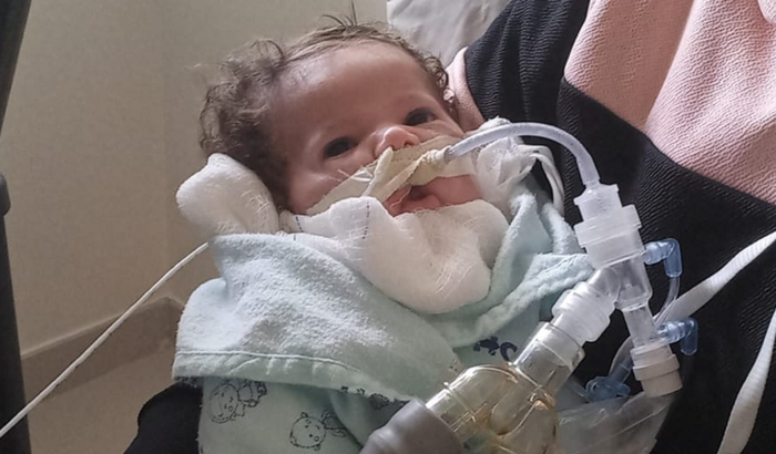 Aspirador Elétrico Domiciliar De Secreção Para Traqueostomia