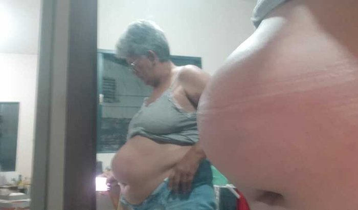 Cirugia de hérnia intestinal