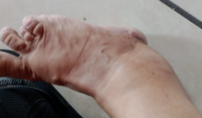 Exames e cirurgia do pé direito com urgencia