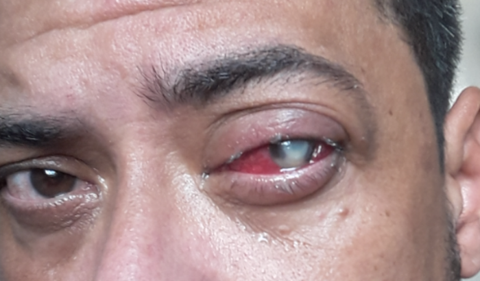 Transplante de Córnea