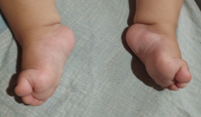 Bota ortopedica 