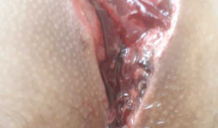 CIRURGIA CISTO PILONIDAL