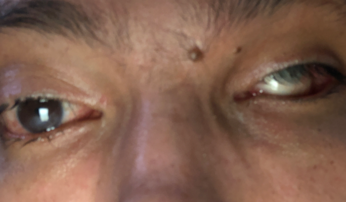 Transplante de olhos