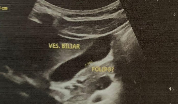 Cirurgia de TUMOR NA VESÍCULAS