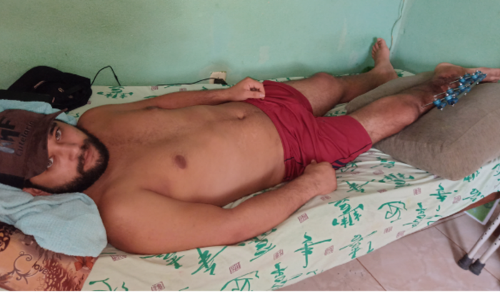 Vaquinha em prol minha cirurgia na Tibia. Transplante ósseo já tenho 10 meses com o fixador e já está saltando