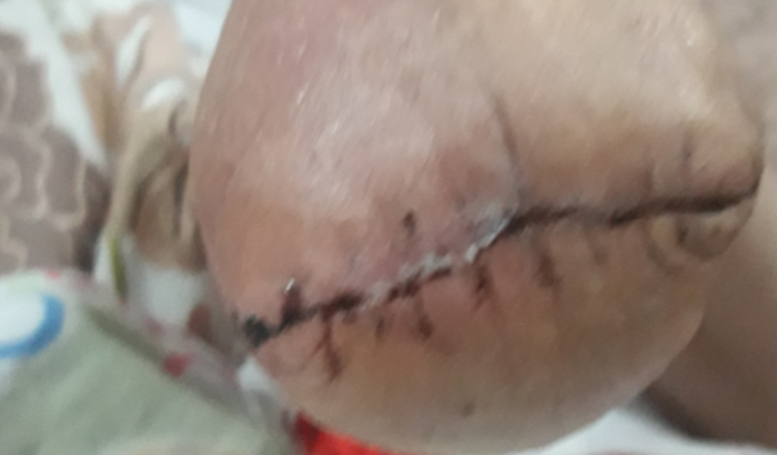 Prótese de canela e pé direito.