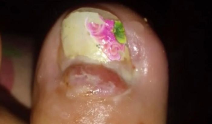 Ajudar no procedimento de raspagem no dedo do pé da Adriana