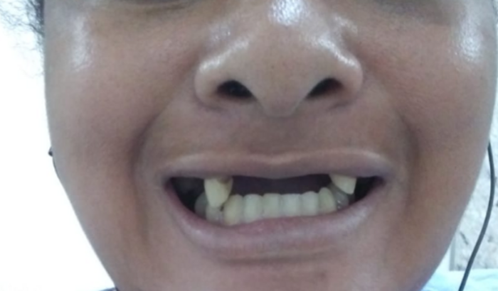 Problema na arcada dentária e tenho q arrancar e fazer uma prótese ou oq o Dinho der e não tenho condições .