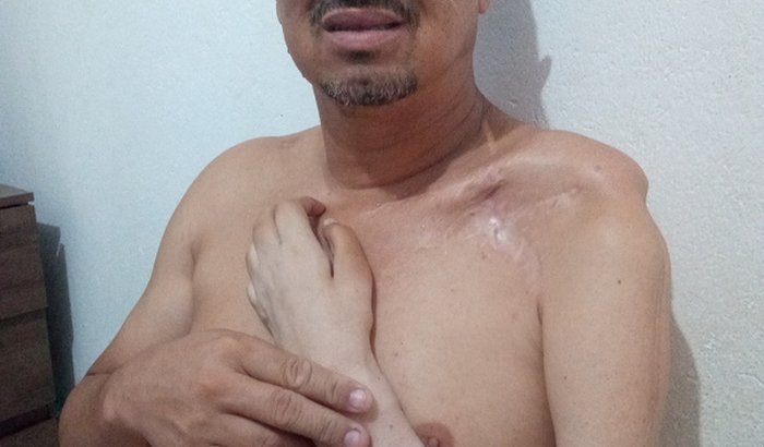 Cirurgia para restaurar movimento do meu braço.
