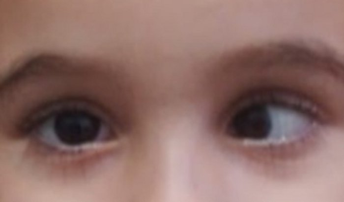 Ajude a Bia fazer cirurgia de estrabismo urgente