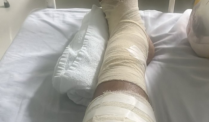 Quebrei a tibia estou sem renda 