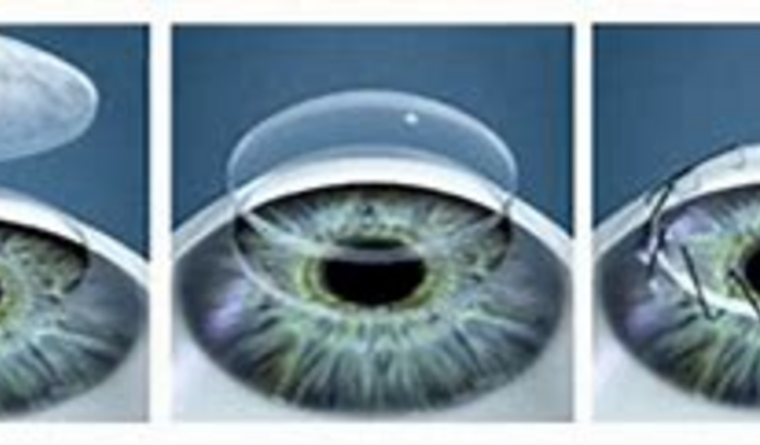 Cirurgia: Anel de Ferrara e Lente de contato.