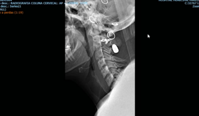 Cirurgia para retirar Projétil Alojado no Pescoço