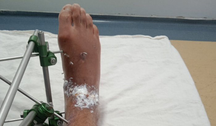 Custeio enquanto meu esposo estiver hospitalizado e não receber o seguro DPVAT nem o INSS