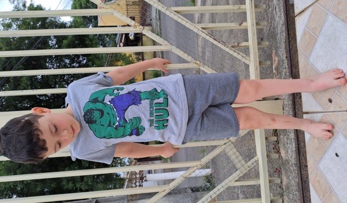 cirurgia de Hemimelia Fibular