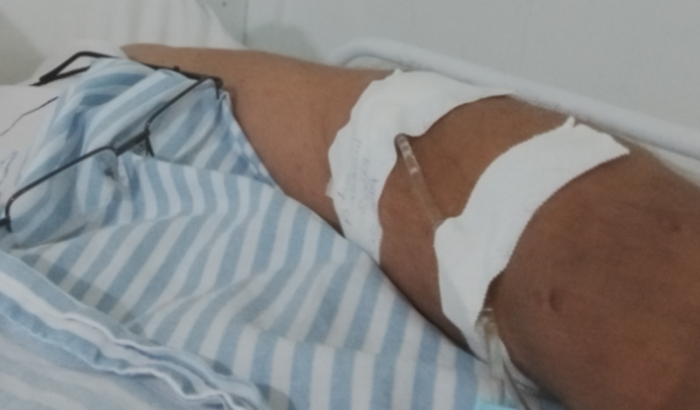 Cirurgia de retirada de pedra no rimm