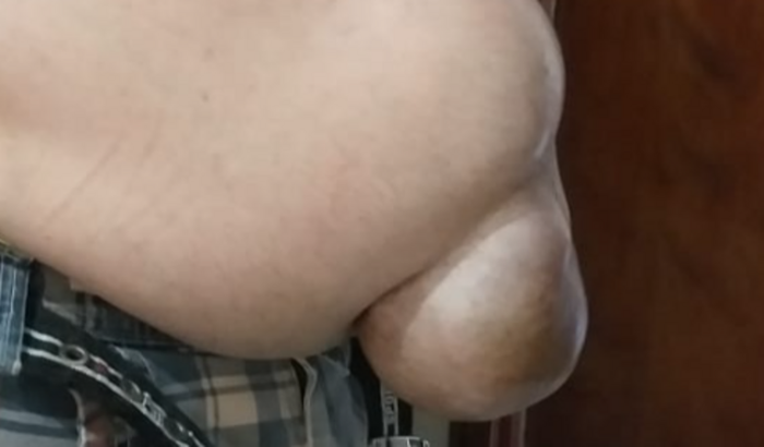 Cirurgia de alto risco, hérnia Incisional