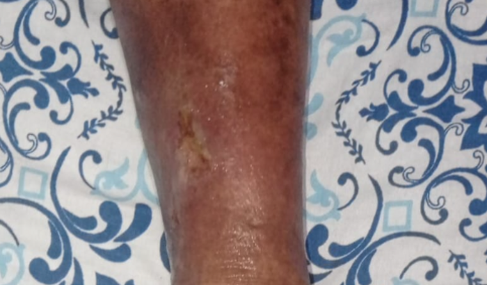 Em prol da cirurgia de endolaser com técnica atta em perna esquerda