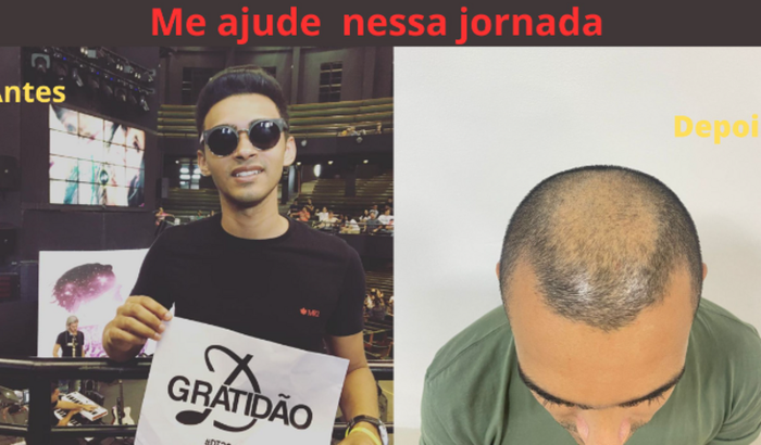 Ajuda Para Implante de Cabelo