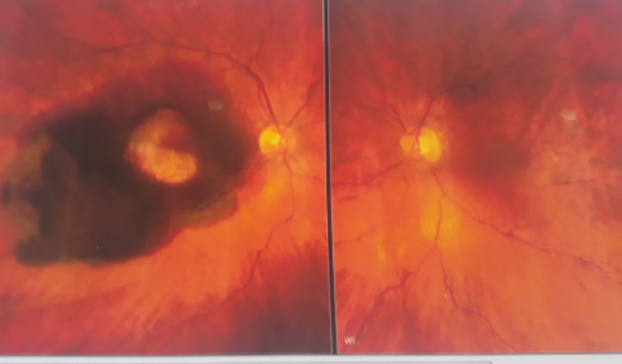 Cirurgia da vista direita.