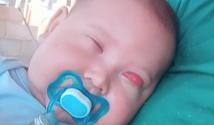 Ajuda para o primeiro tratamento da anoftalmia bilateral do Ethan